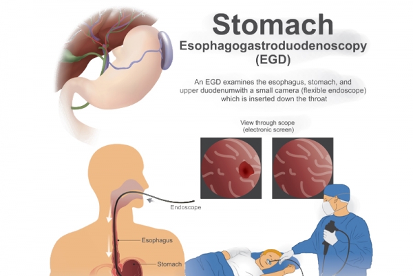 Esophagogastroduodenoscopy EGD S First Surgery Center